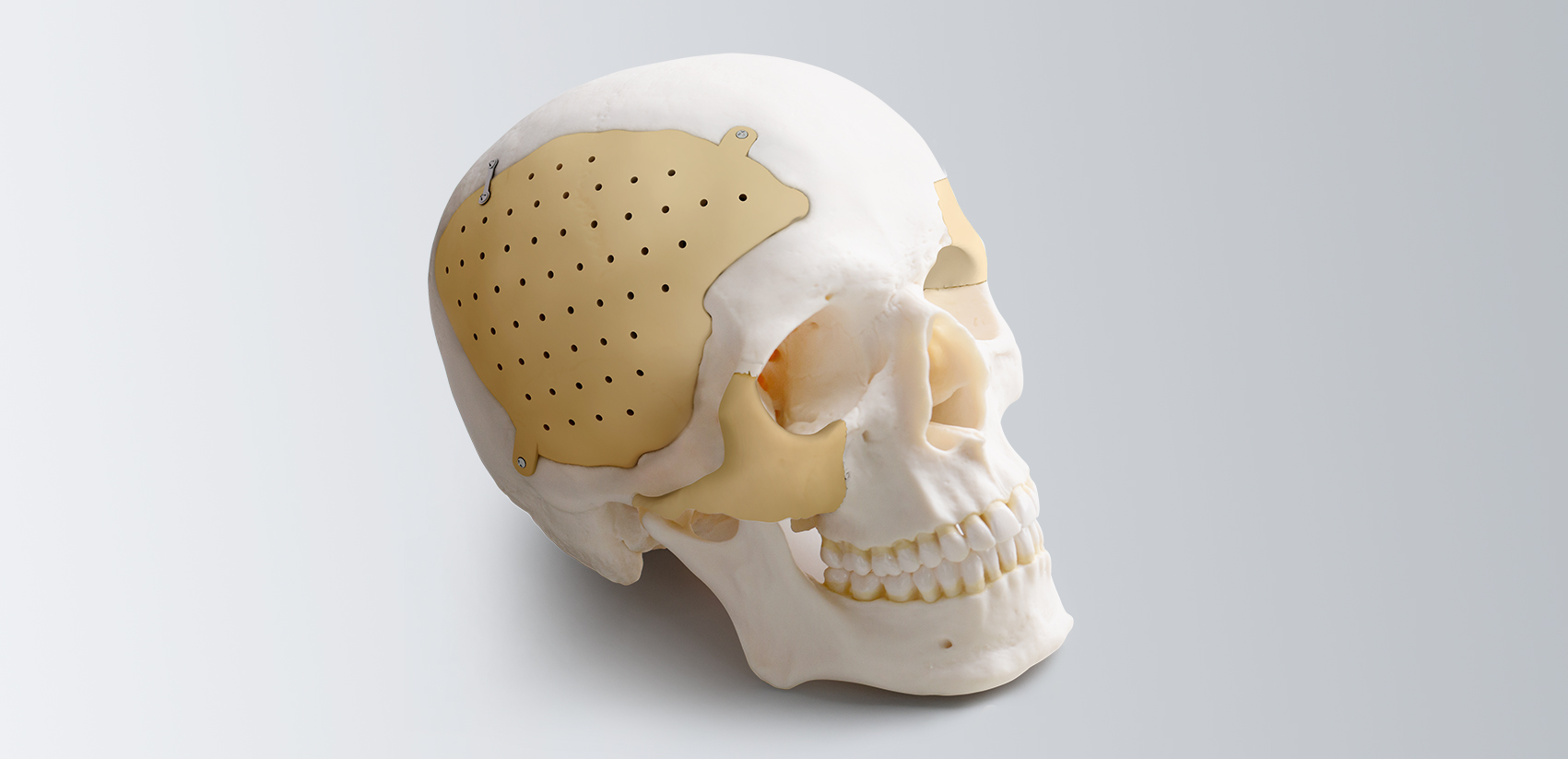 Recranio™ Customized Cranio-Maxillofacial Repair System